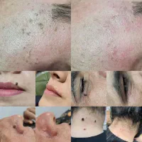 خال برداری-برداشتن خال،نشانه،منگلوله گوشتی