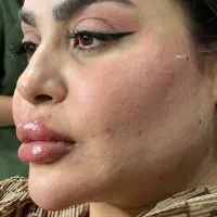 ژل فیلر بوتاکس جوانساز نخ رفع تیرگی