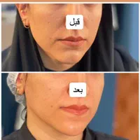 هایفوتراپی14بعدی برای نخستین بار در غرب کشور|خدمات آرایشگری و زیبایی|خرم‌آباد, |دیوار