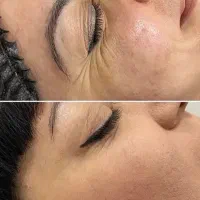 تخفیف ویژه میکرووژل بوتاکس|خدمات آرایشگری و زیبایی|بیرجند, |دیوار