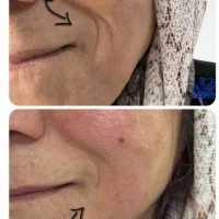 جشنواره  یلدایی تزریق ژل فقط و فقط هر سیسی ۱ ملیون|خدمات آرایشگری و زیبایی|همدان, |دیوار