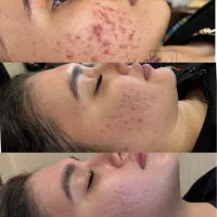 ژل ،بوتاکس، کوچک کردن بینی ،جوانسازی در کیلینیک|خدمات آرایشگری و زیبایی|کرمانشاه, |دیوار