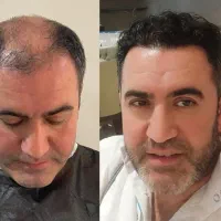 کاشت مو و ابرو تخصصی|خدمات آرایشگری و زیبایی|رشت, گلسار|دیوار