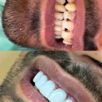 یلدا با تخفیف کامپوزیت|خدمات آرایشگری و زیبایی|ارومیه, |دیوار