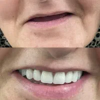 دندان مصنوعی