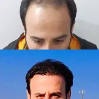 کاشت مو فول تراکم تضمینی|خدمات آرایشگری و زیبایی|گرگان, |دیوار