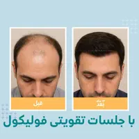 پیوند/ مو ابرو / روش DHI / با خط رویش پنهان|خدمات آرایشگری و زیبایی|تهران, دروس|دیوار