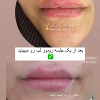 ریموو،پاک کردن تتوی صورت|خدمات آرایشگری و زیبایی|دوگنبدان, |دیوار