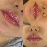 نیازمند مدل رایگان فیلر بوتاکس و prp کاشت نخ