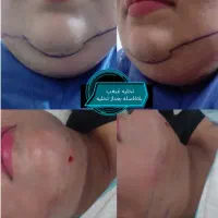 تزریق چربی تخلیه غبغب جراحی بلفاروپلاستی حفره بینی|خدمات آرایشگری و زیبایی|کرج, باغستان|دیوار