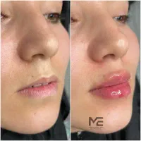 ژل و پیرسینگ چالگونه میکرودمال