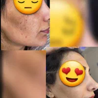 درمان تک جلسه ای تضمینی کک و مک ،لک،اسکار ،جوش