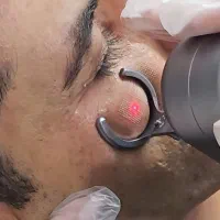 افرتابستانه از بین بردن تخصص جای جوش و اسکار پوستی|خدمات آرایشگری و زیبایی|شیراز, باهنر|دیوار