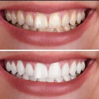 کامپوزیت ایمپلنت ارتودنسی بندرعباس|خدمات آرایشگری و زیبایی|بندرعباس, |دیوار