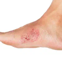 بهبود ریشه ای دیابت .گیاهی