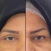 بلفاروپلاستی فقط ۱۳ تومن