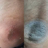 رفع پینه قوزک اقاوخانوم تیرگی زانو و زیر بغل