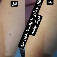 خال برداری پلاسما پلاکسر پاکسازی آموزش هم داده