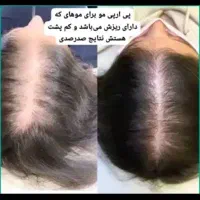 جشنواره ‌.فیلر،ژل،بوتاکس،پی آرپی