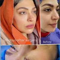 بلفاروپلاستی پلک وسانترال لب 9.360|خدمات آرایشگری و زیبایی|اصفهان, شهشهان|دیوار