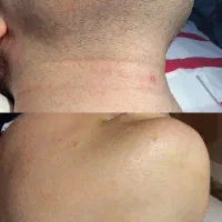 لیزر موهای زائد با دستگاه الکساندرایت کندلا (شاتی)