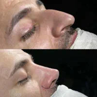 عمل بینی لیفت صورت اقساط تا۲۴ ماه|خدمات آرایشگری و زیبایی|تهران, تجریش|دیوار