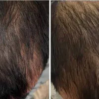 پرپشت شدن مو و رویش موی جدید