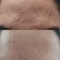 رفع کک و مک و لک . خال . اسکین تگ در یک جلسه|خدمات آرایشگری و زیبایی|بیرجند, |دیوار