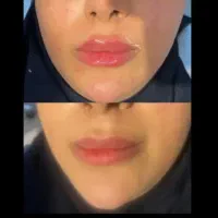 تزریق فیلر و بوتاکس توسط پزشک متخصص