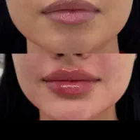 لیزر موهای زائد فول بادی ۸۹۰ ضمانت بازگشت وجه