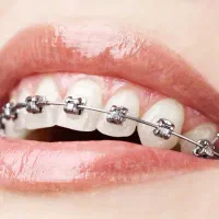 ارتودنسی  دندان با شرایط اقساطی ویژه