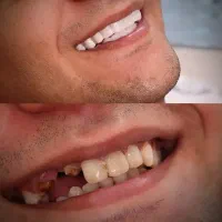 لمینت متحرک دندان