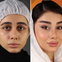 جراحی لیفت اندوسکوپ پیشانی وشقیقه ابرو وصورت متخصص