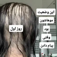 مشاوره رویش مو