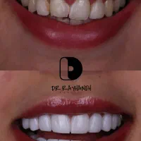 کامپوزیت دندان/لمینیت/دندانپزشکی|خدمات آرایشگری و زیبایی|مشهد, کوثر|دیوار