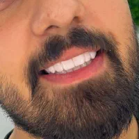 کامپوزیت دندان با تخفیف۵۰درصدی درگرگان