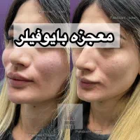 تزریق بایوفیلر کل صورت نچرال و طبیعی