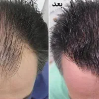 جشنواره تخفیف پی آر پی(PRP)/مزونیدلینگ مو و صورت|خدمات آرایشگری و زیبایی|اصفهان, جلفا|دیوار