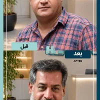 کاشت مو با تراکم بالا و ضمانت مادام‌العمر»