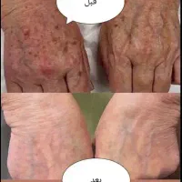 جشنواره یلدا درمان تضمینی کک و مک/زگیل/فقط در1جلسه