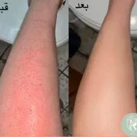 لیزر موهای زائد با بروزترین دستگاه(50% off)