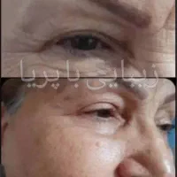 پوستت رو ۲۰ سال جوونتر کن|آرایشی، بهداشتی، درمانی|املش, |دیوار