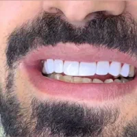 کامپوزیت دندان تخفیف بهاری فکی ۱۲ تومن