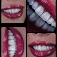 مرکزتخصصی ایمپلنت بدون دردو خونریزی/وام قرض الحسنه