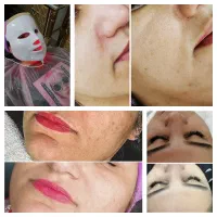 فشیال و پاکسازی پوست