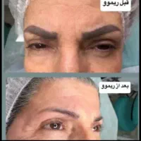 ریموو(ابرو)