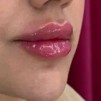 تزریق ژل لب و بوتاکس/ مزو ژل لیفت نخ و فیلربادی