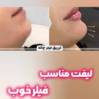 جشنواره تزریق ژل و بوتاکس|خدمات آرایشگری و زیبایی|اصفهان, دانشگاه اصفهان|دیوار