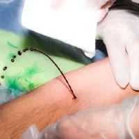 فصد پیشانی حجامت زالو درمانی