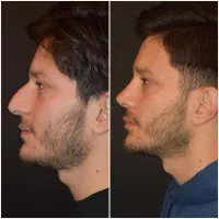 آف محدود جراحی بینی